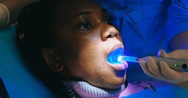 How Teeth Whitening Works: Types and Potential Side Effects