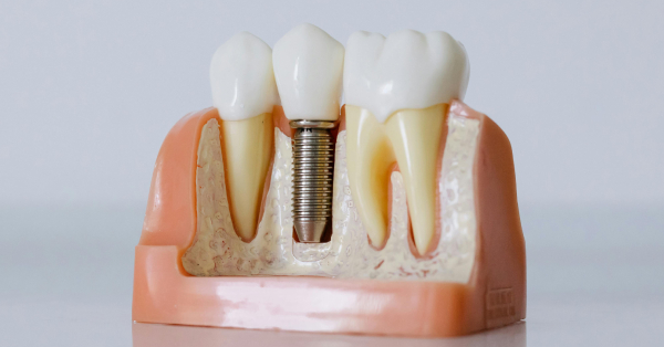 5 Key Signs You May Need Dental Implants in Garland